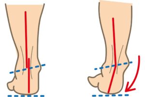 子どもの扁平足（へんぺいそく）、心配し過ぎなくていい？