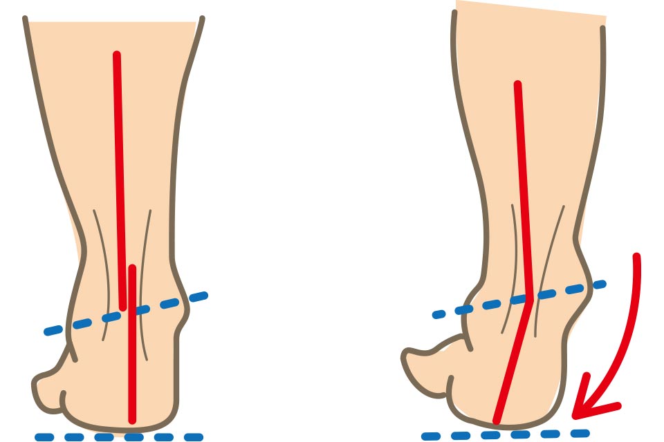 子どもの扁平足（へんぺいそく）、心配し過ぎなくていい？